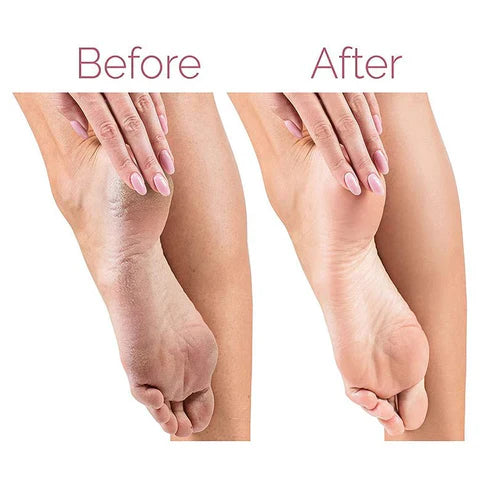 Electric Pedicure Foot File – Callus Remover for Smooth Feet